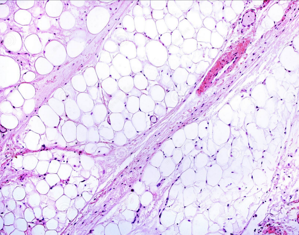 lipœdème 
drainage lymphatique 
ostéopathe 
compiègne